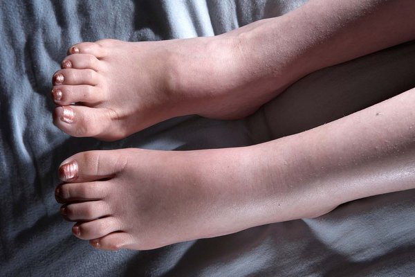 A_1118_oedema_AXT1NP.max-600x600